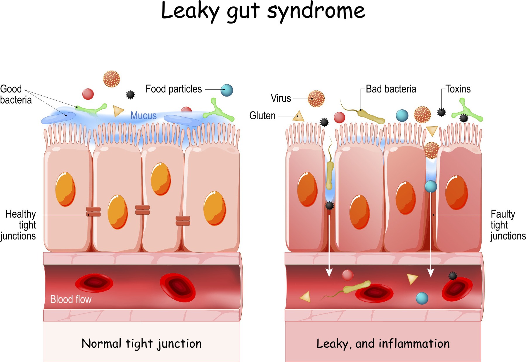 Leaky gut syndrome